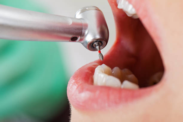 Best Emergency Tooth Extraction in Preston, TX